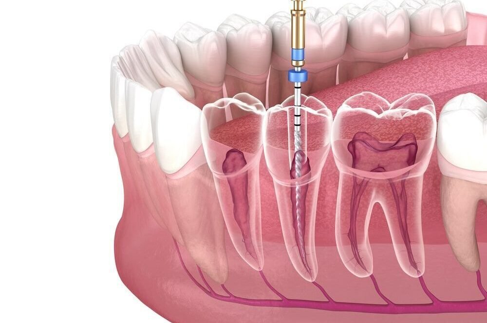 Endodontics (Root Canal Treatment)